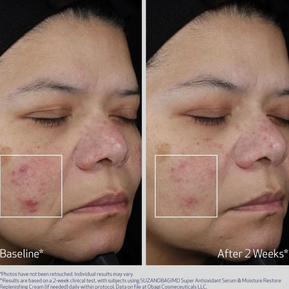 Obagi Medical Obagi Super Antioxidant Serum Discount