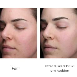 Skinbetter-Science Skinbetter AlphaRet Clearing Serum Discount