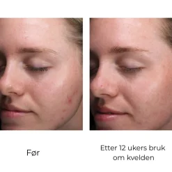 Skinbetter-Science Skinbetter AlphaRet Clearing Serum Discount