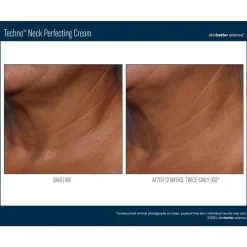 Skinbetter-Science Skinbetter Techno Neck Perfecting Cream Discount