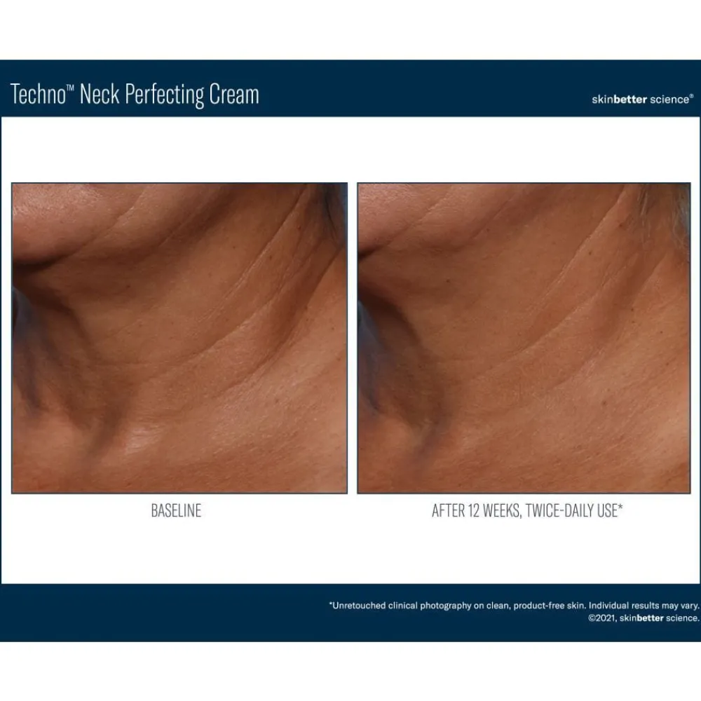 Skinbetter-Science Skinbetter Techno Neck Perfecting Cream Discount